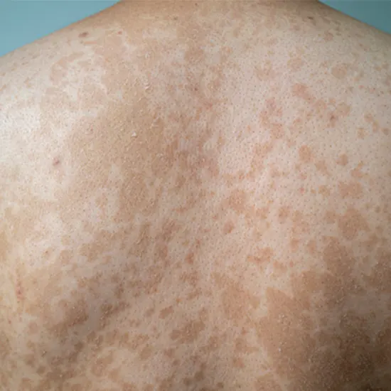 Clear Skin Is Possible : Beat Tinea Corporis